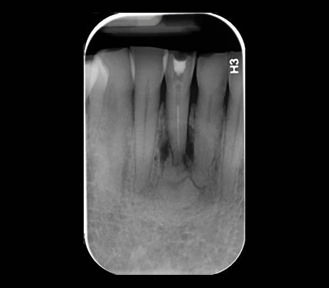 Intraoral Film